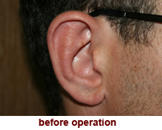 plastic-surgery-prominent-ear 